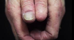 Ingrown toenails (onychocryptosis) result when the toenail grows into the nail fold. Doctors Warn About Skin Cancer Under Fingernails
