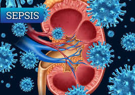 Este tipo de enfermedad puede aparecer debido a cualquier tipo de bacteria, hongos y virus incluidos. Dano Renal Agudo Asociado A Sepsis Articulos Intramed