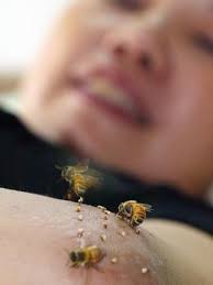 Linda Blatt gets stung by bees three times a week to treat Lyme disease