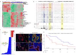 Cancers that have spread to surrounding tissues also have a poorer prognosis. Pancreatic Cancer Prognosis Is Predicted By An Atac Array Technology For Assessing Chromatin Accessibility Nature Communications