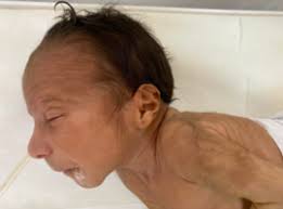 Navigating the Challenges of Edwards Syndrome: A Compelling Case Study