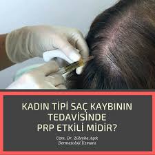 Kadin Tipi Sac Kaybinin Tedavisinde Prp Etkili Midir Hastalarin Cogunda Prp Tedavisi Basarilidir 6 Aydan Daha Az Bir Zamanda Gorulen Kadin Sac Dokulmesi Sac