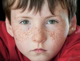 Image result for Freckled skin
