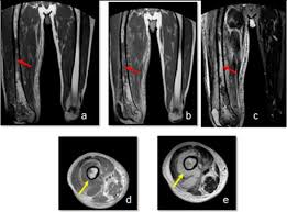 The flexor digiti minimi brevis (flexor brevis minimi digiti, flexor digiti quinti brevis) lies under the metatarsal bone on the little toe, and resembles one of the interossei. Imaging Of Acute Unilateral Limb Swelling A Multi Modality Overview Sciencedirect
