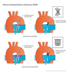 A personal digital assistant (pda), also known as a handheld pc, is a variety mobile device which functions as a personal information manager. Pda Patent Ductus Arteriosus Closure Rodnie Oro