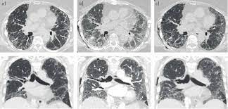 A 63 Year Old Woman With Rheumatoid Arthritis Associated Interstitial Download Scientific Diagram