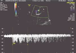 normal fetal heart rate of 140 bpm and normal ductus venosus