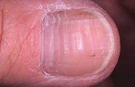 Nails Horizontal Ridges Beau S Lines Fragile Healthy Nails Nail Ridges Beaus Lines Nails