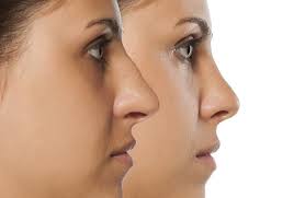 It is also one of the few surgical procedures that a person's health insurance may partially or fully cover the expense. Cosmetic Vs Medical Reasons For A Nose Job Rhinoplasty In Houston