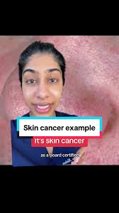 Image result for skin cancer on nose pimple