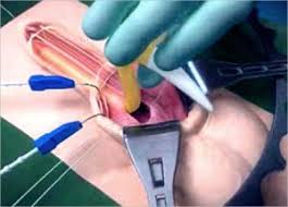 Urut zakar teknik jelqing ini adalah sejenis teknik urut zakar yang melibatkan urutan dan regangan zakar (mirip perbuatan melancap) bermula di melalui penggunaan daya yang sederhana atau sedikit kuat, urut zakar teknik jelqing ini akan mengakibatkan kekoyakkan tisu pada skala mikro pada tisu. 6 Cara Paling Senang Untuk Dapatkan Zakar Yang Besar Tegang Tebal