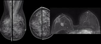 Image result for Mammogram Interpretation