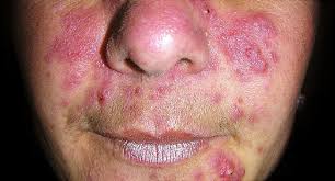 Often, the nose, cheeks, forehead, and chin are most involved. Rosacea Types Symptoms And Treatment