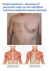 Aka poland anamoly or poland sequence. Poland Syndrome Poland Syndrome Pectoral Muscles Major Muscles