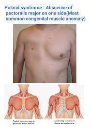 Poland syndrome is a birth defect characterized by an underdeveloped chest muscle and short webbed fingers on one side of the body. Poland Syndrome Poland Syndrome Pectoral Muscles Major Muscles