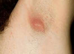 It may be a major discomfort particularly. Ingrown Hair Armpit Cyst Lump Picture Infected Symptoms How To Get Rid Healthrid