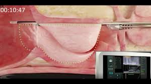 Suyla Prostat Ameliyati Nasil Yapiliyor Prof Dr Murat Binbay Uroloji Uz Youtube