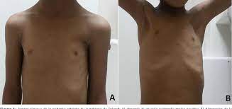 Normal life expectancy poland syndrome with atypical malformations associated to a de novo 1.5 mb xp22.31 duplication. Figure 1 From Syndrome De Poland A Propos D Un Cas Et Revue De La Litterature Semantic Scholar