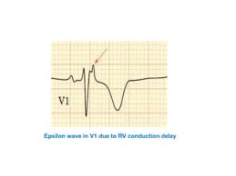Image result for Epsilon Wave