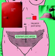 Our experience shows that laparoscopic entry using the left upper quadrant is. First Abdominal Access In Gynecological Laparoscopy Comparison Of Techniques Springerlink