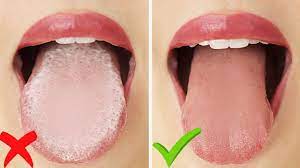 83940) explains the importance of cleaning the tongue. How To Get Rid Of White Tongue Bad Breath Instantly Youtube