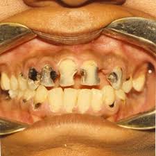 Masalah karies pada anak atau dikenal sebagai sindroma karies botol (skb) sering frekuensi minum susu botol dua kali atau lebih per hari juga akan meningkatkan risiko kejadian skb 2,27 kali. Biarkan Anak Tidur Sambil Hisap Botol Susu Punca Karies Gigi Doktor Gigi Ini Nyatakan Langkah Perlu