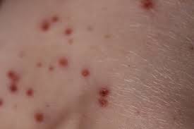 Den vanliga dos en är 1000 mg (två tabletter på 500 mg) tre gånger dagligen. Om Vattkoppor Vitaenova