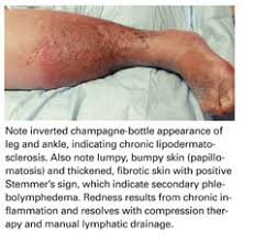 Image result for Pigment stains on the shin