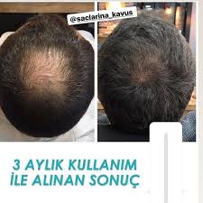 3 Ay Sonuclari Sac Serumumuz Sac Koklerini Eski Gucune Getirir Guclenen Sac Kokleriyle Saclar Yavas Yavas Deri Ustune Cikmaya Baslar Sac Serum Deri
