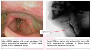 Image result for Vocal Cord Dysfunction