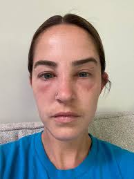 Is facial swelling a normal reaction to a bee sting or a sign of an  allergic response?