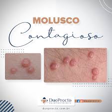 Você sabe o que é Molusco contagioso? - Primazo