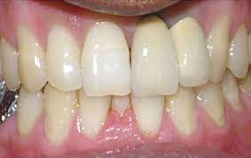 Since demineralizing or lack of minerals are a cause of tooth decay, using fluoride mouthwash can be a great home remedy to get rid of cavities as well as tooth decay. Dental Filling And Tooth Cavity Filling Cost Treatment Causes