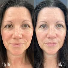 Neo-filler results after 12 weeks