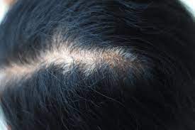 There's a multitude of evidence showing links between stress and hair loss, but it's also known that stress can lead to hair breakage. Does Rogaine Work Effectiveness For Hair Loss Beards And Women