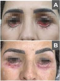 Integrated management of facial harmonization complications using ozone  therapy: A description of 2 cases
