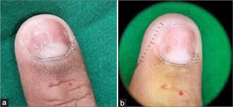 Image result for Onychotillomania feet