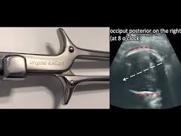 They also have a sliding mechanism that can be helpful when the baby's head isn't in line with the mother's. Seeing Is Believing Kielland S Forceps Rotation Under Ultrasound Youtube