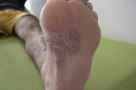 Pathophysiology:typically present in agricultural workers(hands fungi grow more quickly than actinomycetes. Madura Foot Report Of A Eumycetoma Moroccan Case Sciencedirect