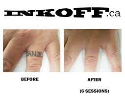 There's no evidence that tattoo removal creams work. 10 Inkoff Laser Tattoo Removal Ideas Laser Tattoo Removal Tattoo Removal Laser Tattoo