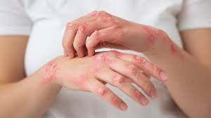 Image result for Leprosy