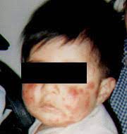 It begins as a rash and bruises on the skin forming red scaly patches on the legs and buttocks. Henoch Schonlein Purpura A Review American Family Physician