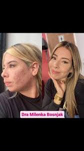 ¡Mira este increíble cambio!😍, Realizado por nuestra dermatóloga  @gotasderociobosnjak , ., ., Dale like y comparte👌, ., ., Dra. Milenka  Bosnjak dermatólogo, 0414-4188402 📱agenda tú cita!.