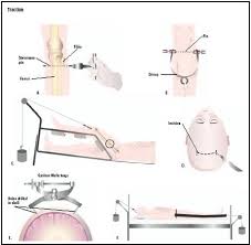 Traction Procedure Blood Pain Complications Infection Types Children Definition