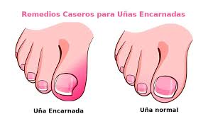 Los Mejores 5 Remedios Caseros Para Unas Encarnadas