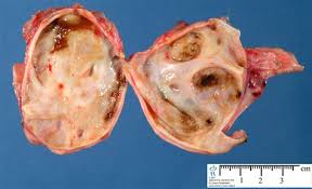 Maybe you would like to learn more about one of these? Dermoid Cyst Pathology Cao L Wang Y Zhao L Hu X Cai C