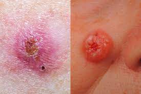 Merkel cell carcinoma can look like a sore this skin cancer often develops on the head or neck and can look like a sore. Skin Cancer Pictures 5 Different Types Of Skin Cancer To Know