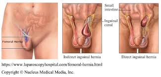 Image result for Inguinal hernia man