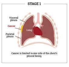 A diagnosis of lung cancer naturally causes some overwhelming emotions, but you don't have to let those emotions get the best of you. Mesothelioma What Are It S Causes Symptoms Prognosis Learn More