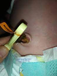 Ombligo Infectado Club Septiembre 2019 Embarazo Y Bebes Babycenter